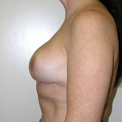 Breast Reduction 62 After Photo