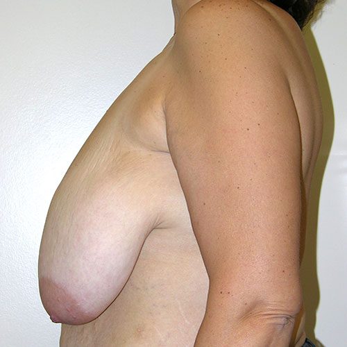 Breast Reduction 63 Before Photo