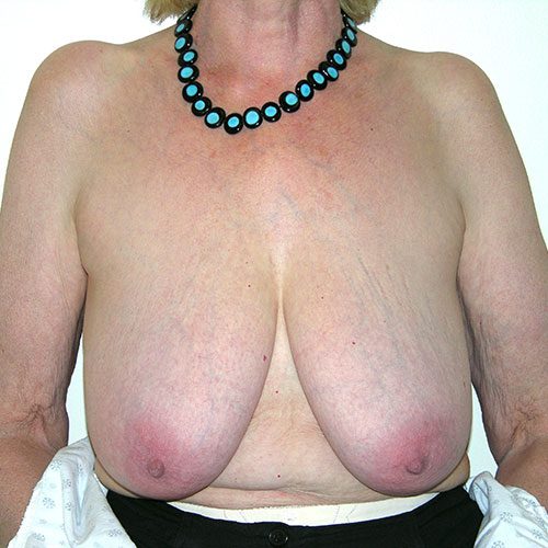 Breast Reduction 65 Before Photo 