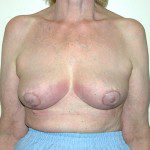 Breast Reduction 65 After Photo - 10