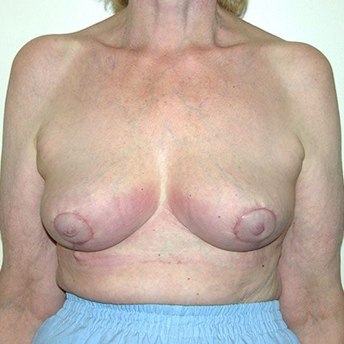 Breast Reduction 65 After Photo 