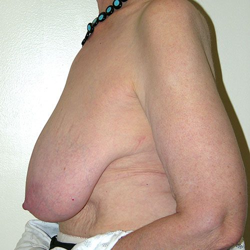 Breast Reduction 65 Before Photo