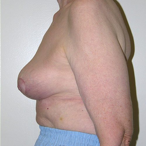 Breast Reduction 65 After Photo