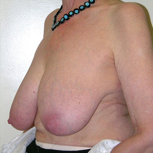 Breast Reduction 65 Before Photo