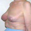 Breast Reduction 65 After Photo Thumbnail