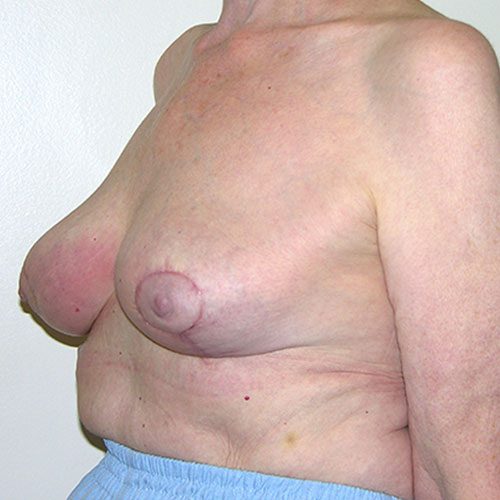 Breast Reduction 65 After Photo