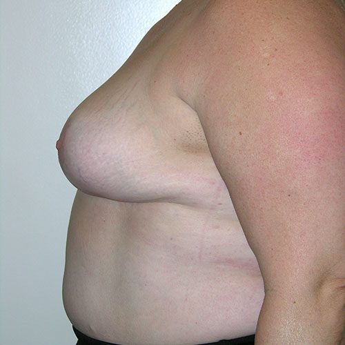 Breast Reduction 66 After Photo