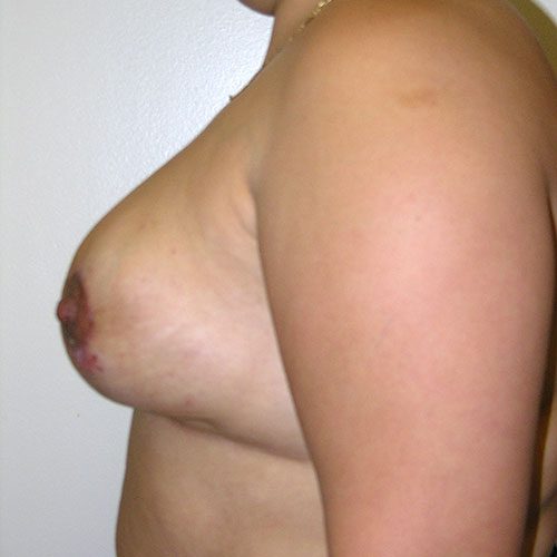 Breast Reduction 67 After Photo