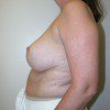 Breast Reduction 68 After Photo Thumbnail