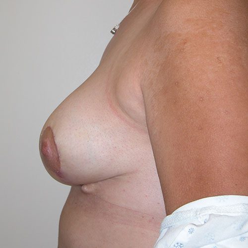 Breast Reduction 69 After Photo