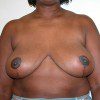Breast Reduction 70 After Photo Thumbnail