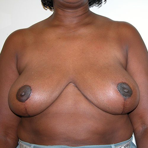 Breast Reduction 70 After Photo 