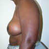 Breast Reduction 70 After Photo Thumbnail