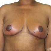 Breast Reduction 73