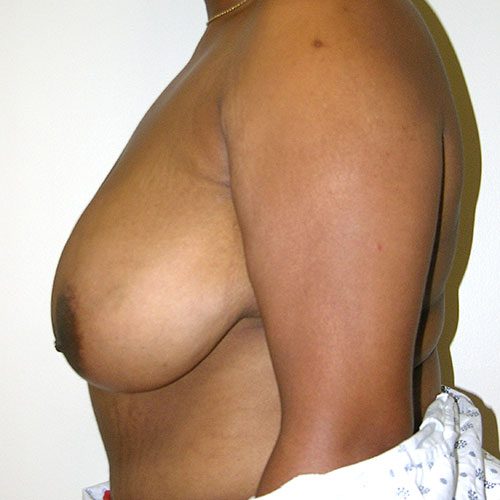 Breast Reduction 73 Before Photo