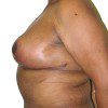 Breast Reduction 73 After Photo Thumbnail