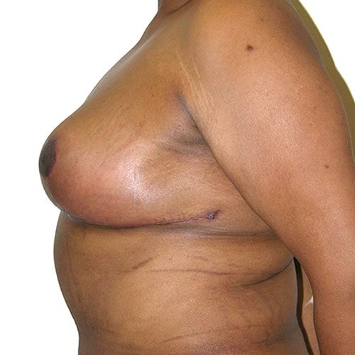 Breast Reduction 73 After Photo