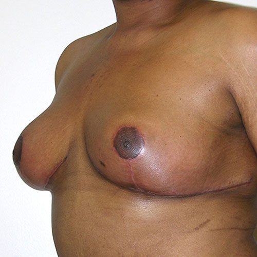 Breast Reduction 73 After Photo