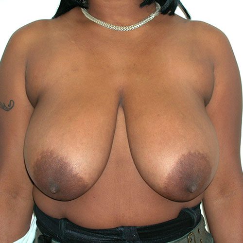 Breast Reduction 74 Before Photo 