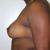 Breast Reduction 74 After Photo Thumbnail