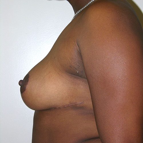 Breast Reduction 74 After Photo