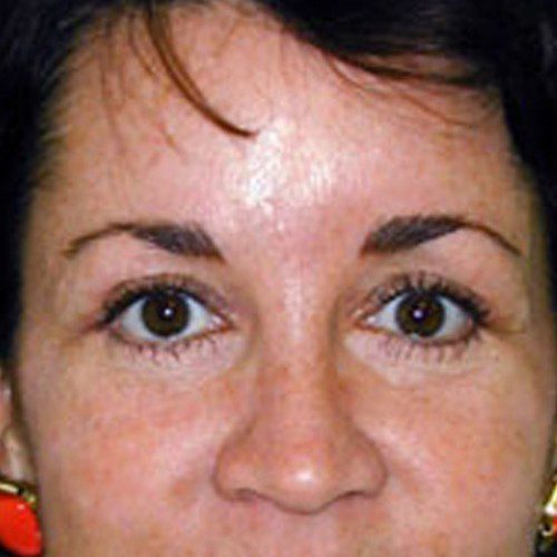 BrowLift 03 After Photo 