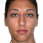 Otoplasty 1 After Photo - 10