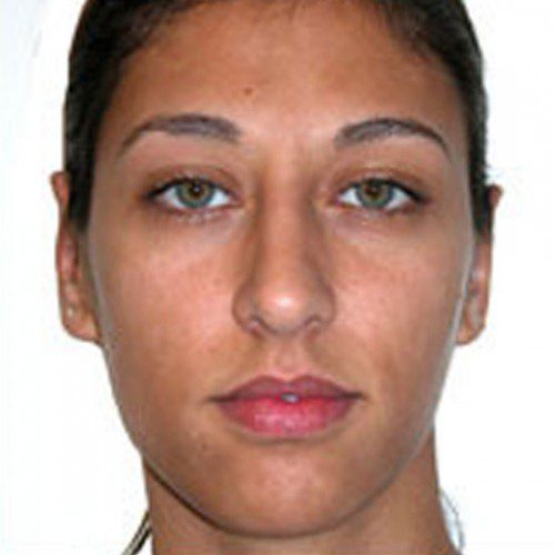 Otoplasty 1 After Photo 