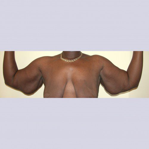 Armlift 10 Before Photo 