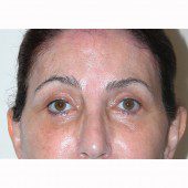 Blepharoplasty 11