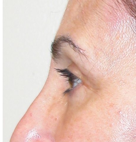 Blepharoplasty 11 After Photo