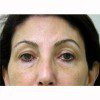 Blepharoplasty 11 Before Photo Thumbnail