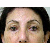 Blepharoplasty 11