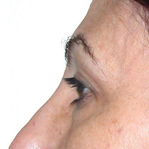 Blepharoplasty 11 Before Photo