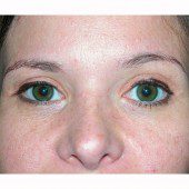Blepharoplasty 13