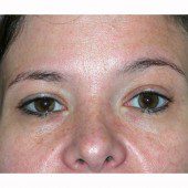 Blepharoplasty 13