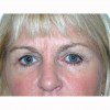 Blepharoplasty 14 After Photo Thumbnail