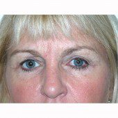 Blepharoplasty 14