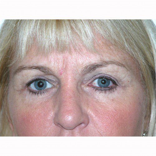 Blepharoplasty 14 After Photo 