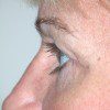 Blepharoplasty 14 After Photo Thumbnail