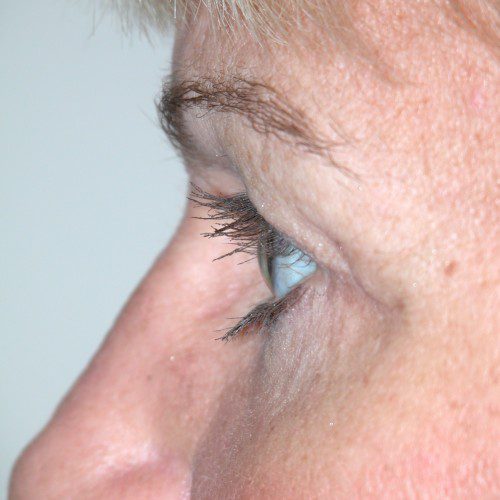 Blepharoplasty 14 After Photo