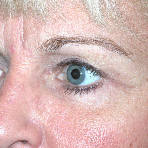 Blepharoplasty 14 After Photo