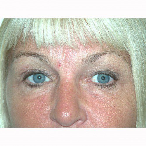 Blepharoplasty 14 Before Photo 