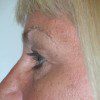 Blepharoplasty 14 Before Photo Thumbnail