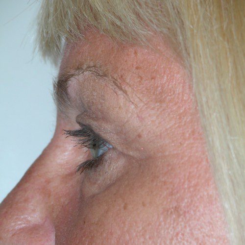 Blepharoplasty 14 Before Photo