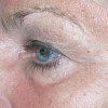 Blepharoplasty 14 Before Photo Thumbnail