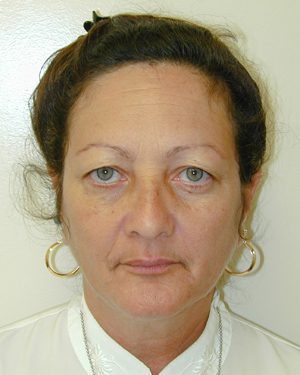 Blepharoplasty 15 Before Photo 