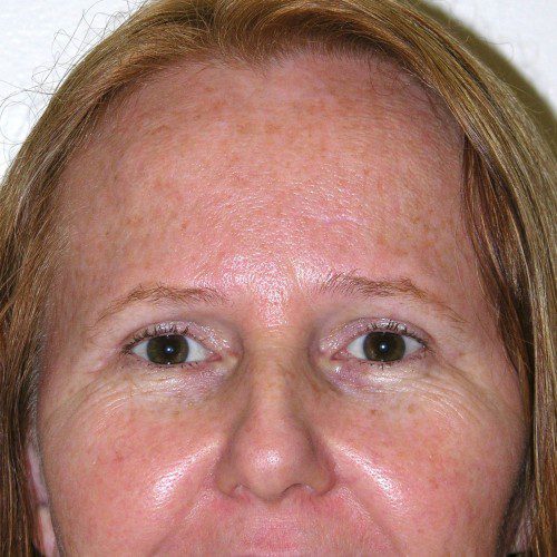 Blepharoplasty 16 After Photo 