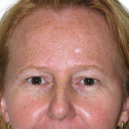 Blepharoplasty 16 Before Photo 