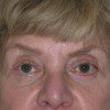 Blepharoplasty 17 After Photo Thumbnail